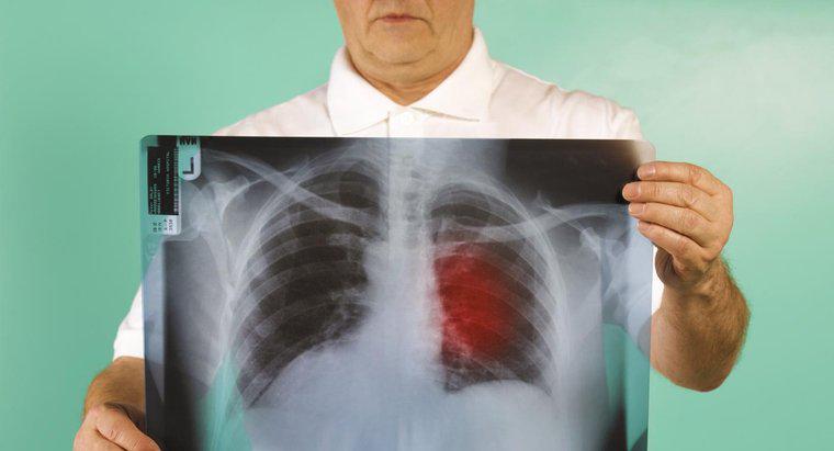 Care este prognoza pentru stadiul trei cancer pulmonar?