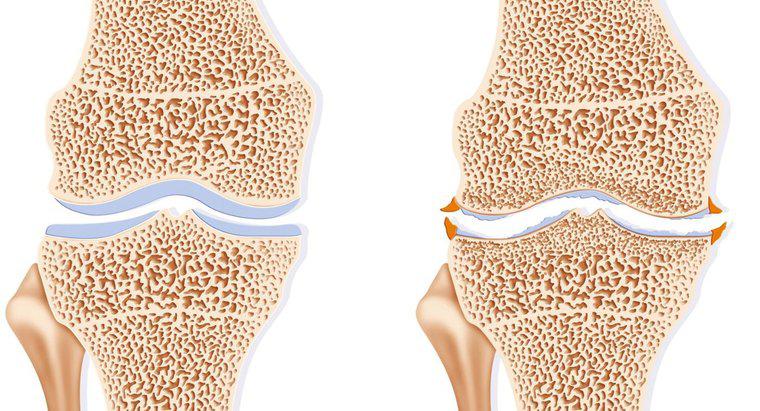 Ce este o formare de osteophyte?