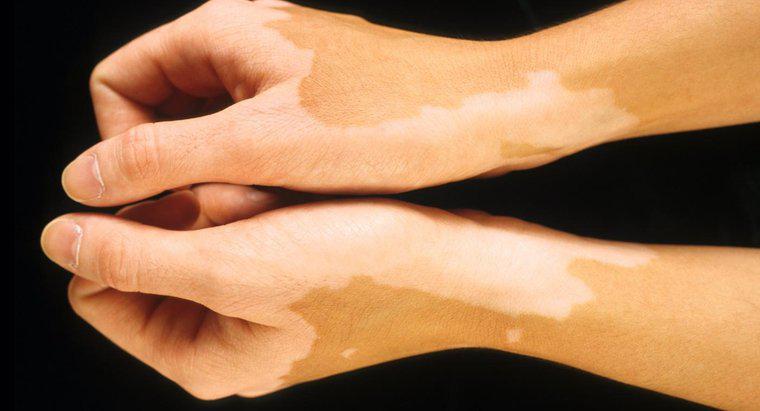 Ce cauzează apariția de pete de lumină pe piele?