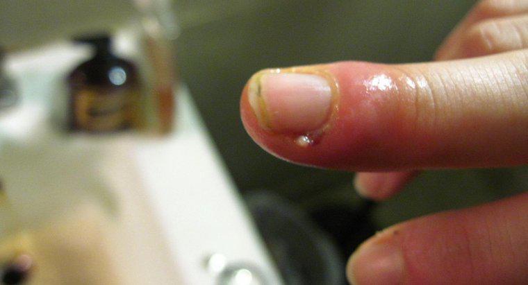 Ce trebuie să facă o persoană cu un deget umflat de la o infecție cuticulară?