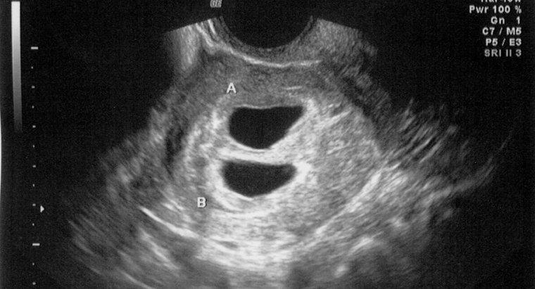 Poate un ultrasunet să detecteze o sarcină la 4 săptămâni?