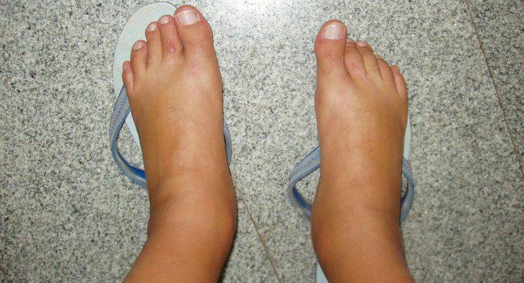 Care sunt cauzele picioarelor umflate?