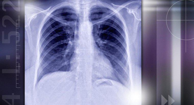 Ce cauzeaza noduli pulmonari?