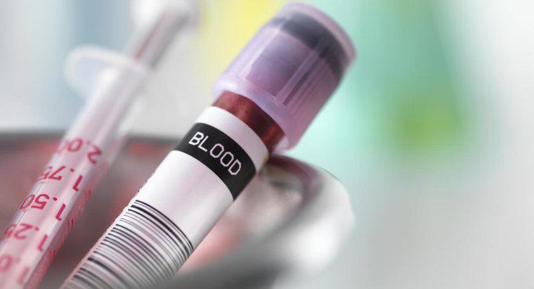 Cum medicii diagnostichează cauza unui număr scăzut de hemoglobină?