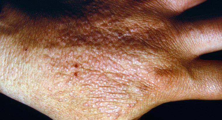 Cum suferă o dermatită?