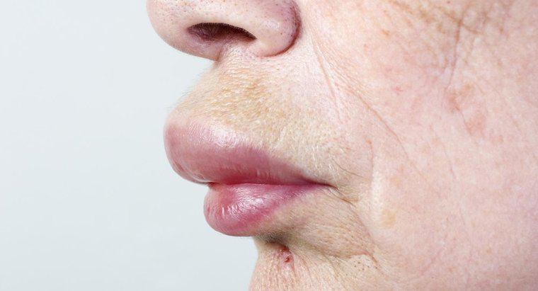 Cum vindecați un buze și o față umflate?