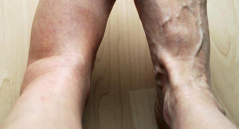 Care sunt unele posibile cauze de durere și umflare la nivelul piciorului stâng?