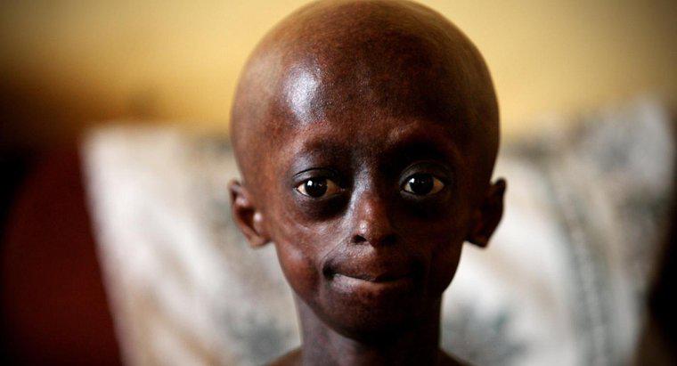 Ce limite are o persoană cu Progeria?