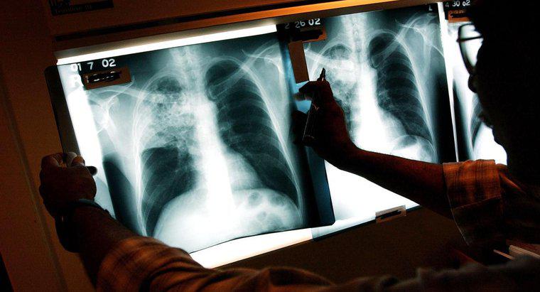 Care sunt efectele pe termen lung ale tuberculozei?