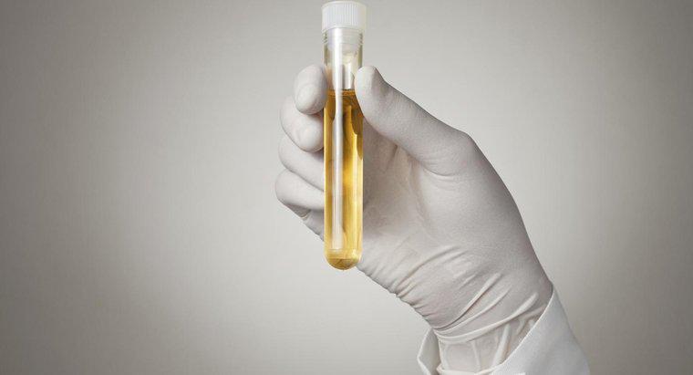 Ce înseamnă aceasta atunci când aveți o proteină mare în urină?