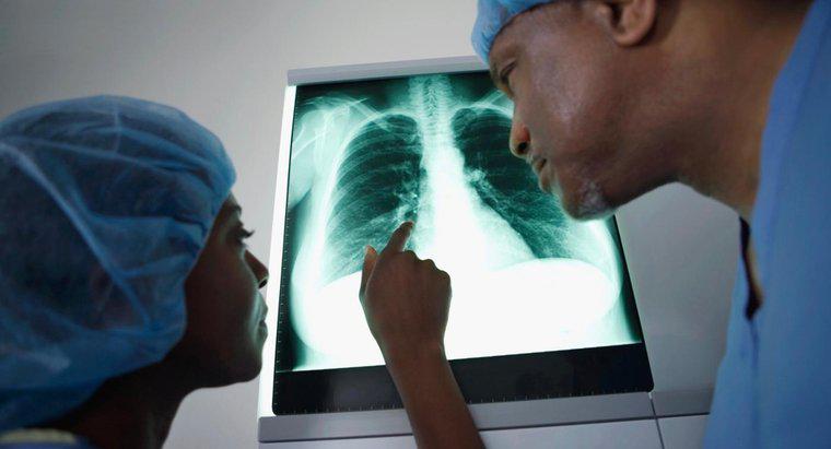 Ce simptome sunt unice pentru cancerul pulmonar?