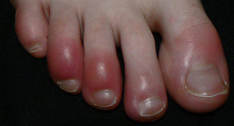 Este degetele roșii un simptom al sindromului Raynaud?