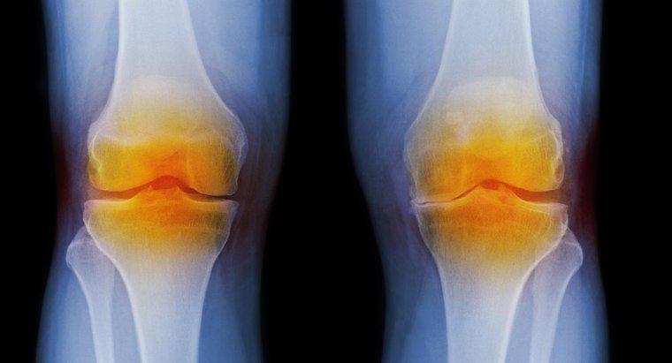 Care sunt simptomele artritei la genunchi?