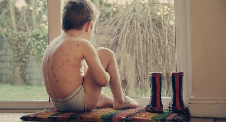 Care parte a corpului afectează varicela?