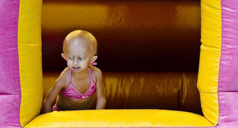 Cât timp puteți trăi cu Progeria?