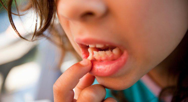 Ce cauzează dinții pierduți la adulți?