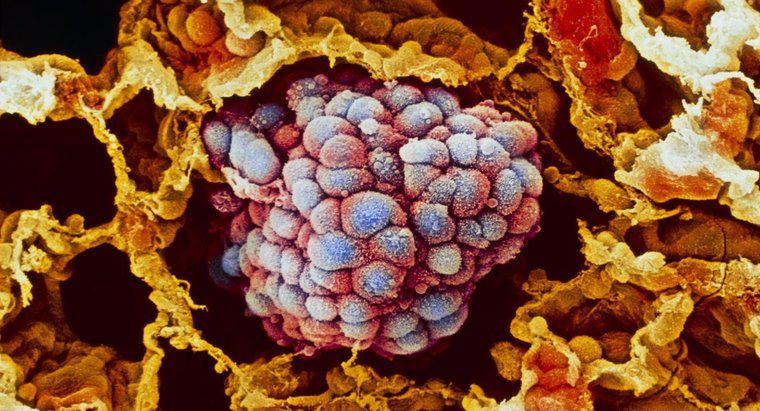 Care sunt celulele precanceroase?