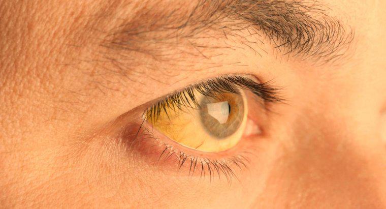 Ce cauzează pielea sub ochi să devină galben?