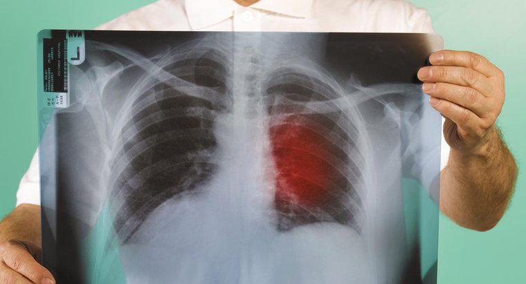 Care sunt primele semne ale cancerului pulmonar?