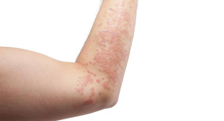 Are Eczema Arata ca Ringworm?