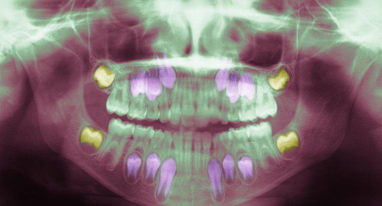 Ce cauzează o infecție a dintelui înțelepciunii?